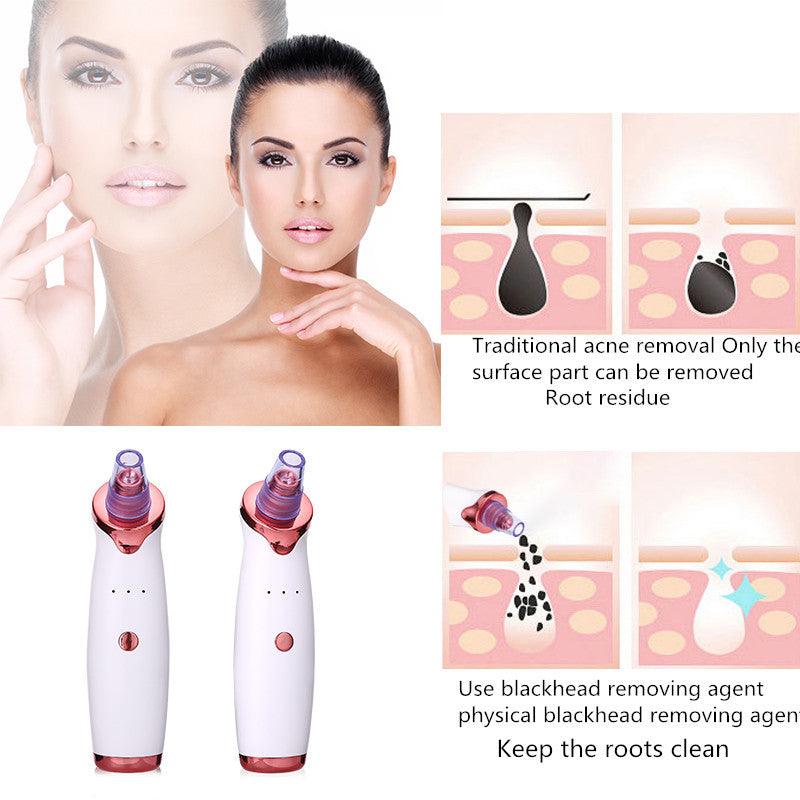 Blackhead Remover Vacuum with 3-Level Suction Power for Acne &amp; Pore Cleansing - Luminessbty